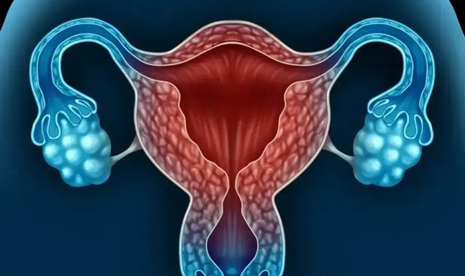 Endometriozis: Kadınların Gizli Düşmanı